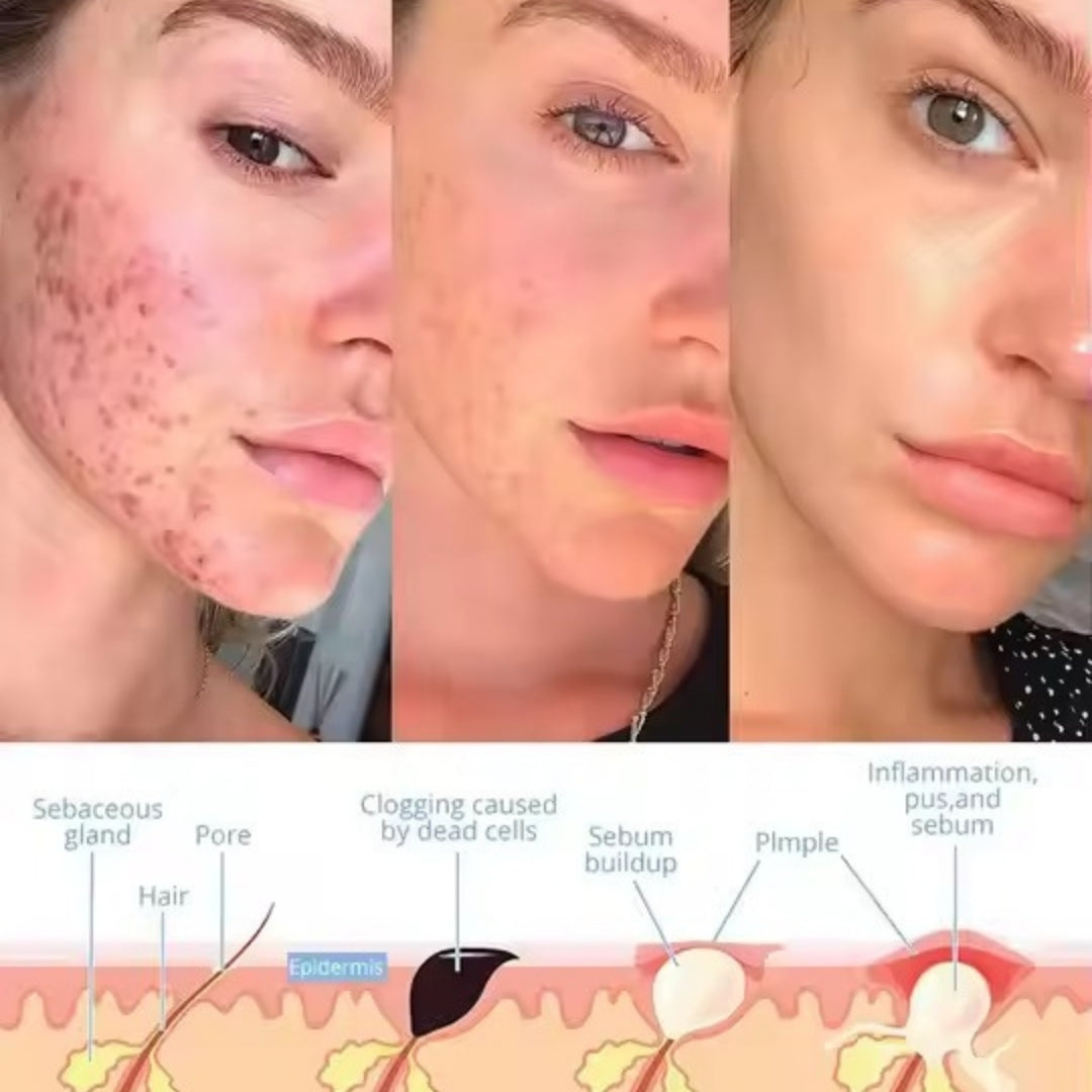 AcuLume™ - Facial Wand