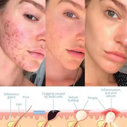 AcuLume™ - Facial Wand